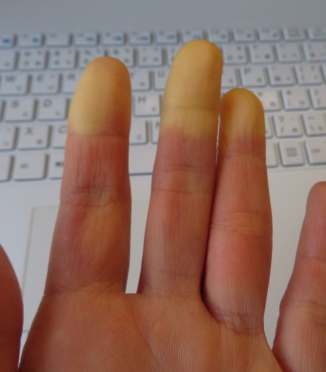 Raynaud's syndrome and sleep — why hands and feet freeze at night and how to fight it