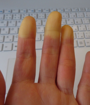Raynaud's syndrome and sleep — why hands and feet freeze at night and how to fight it