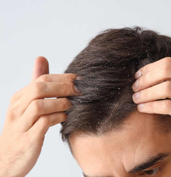 Why do you get dandruff — and is your pillowcase really to blame?